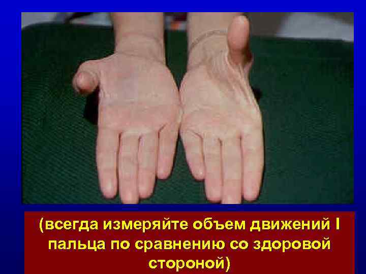 (всегда измеряйте объем движений I пальца по сравнению со здоровой стороной) 