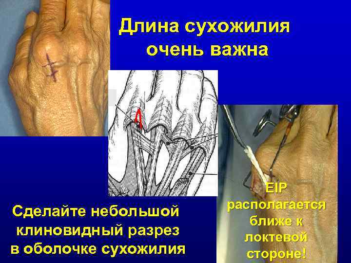 Длина сухожилия очень важна Сделайте небольшой клиновидный разрез в оболочке сухожилия EIP располагается ближе