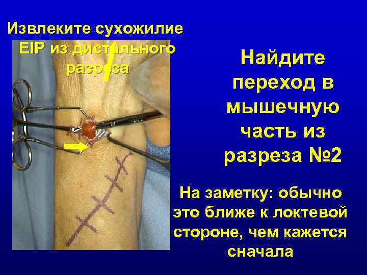 Извлеките сухожилие EIP из дистального разреза Найдите переход в мышечную часть из разреза №