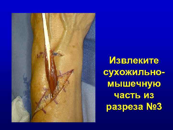 Извлеките сухожильномышечную часть из разреза № 3 