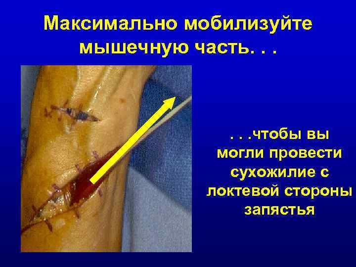 Максимально мобилизуйте мышечную часть. . . чтобы вы могли провести сухожилие с локтевой стороны