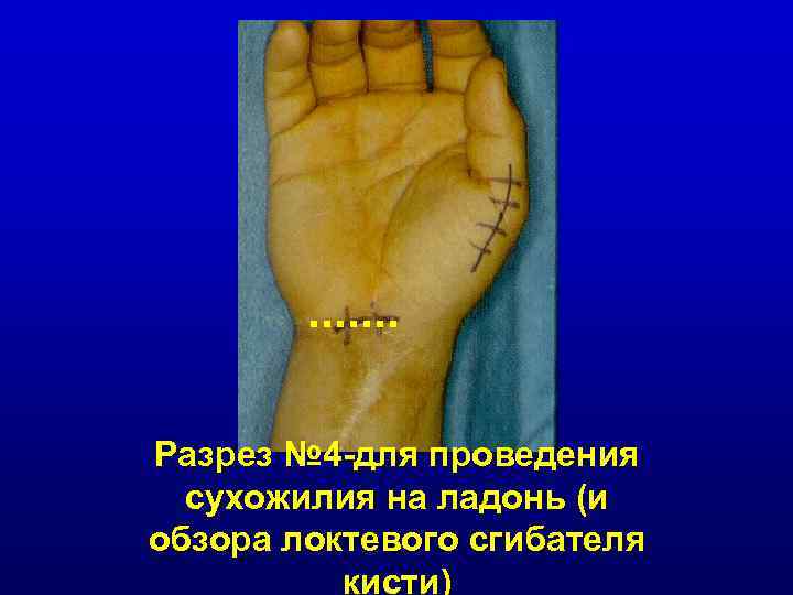 Разрез № 4 -для проведения сухожилия на ладонь (и обзора локтевого сгибателя кисти) 