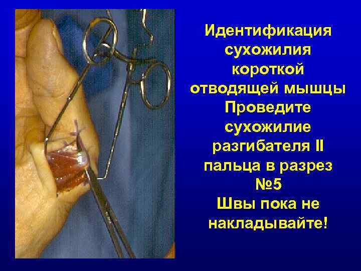 Идентификация сухожилия короткой отводящей мышцы Проведите сухожилие разгибателя II пальца в разрез № 5