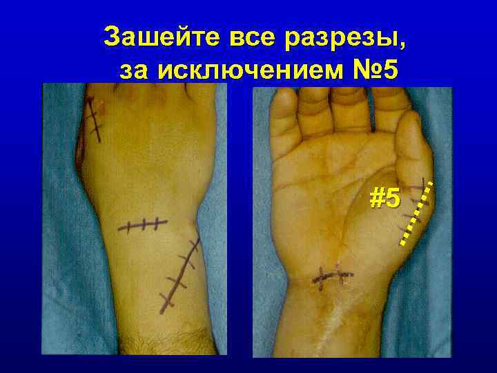 Зашейте все разрезы, за исключением № 5 #5 