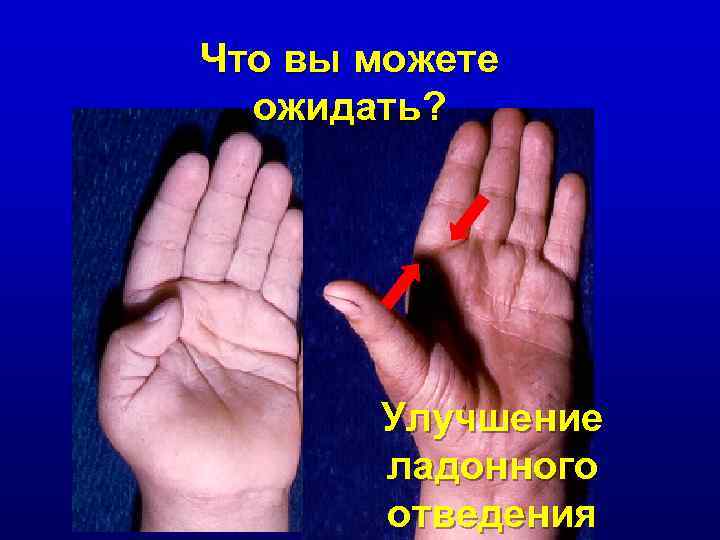Что вы можете ожидать? Улучшение ладонного отведения 