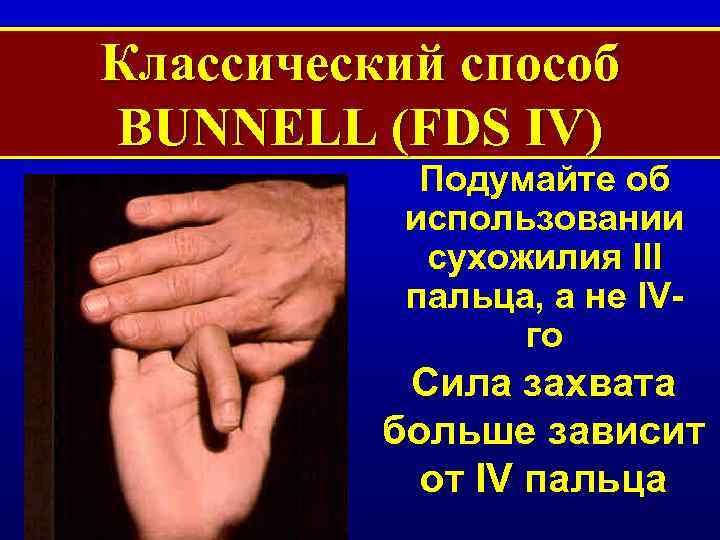 Классический способ BUNNELL (FDS IV) Подумайте об использовании сухожилия III пальца, а не IVго