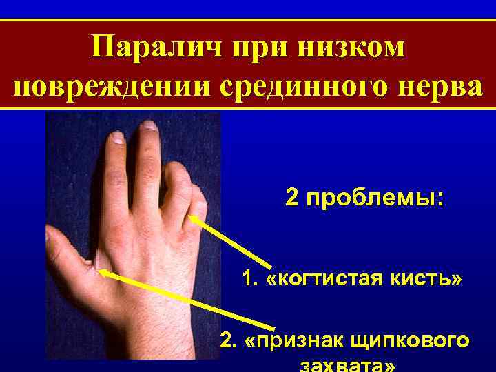 Паралич при низком повреждении срединного нерва 2 проблемы: 1. «когтистая кисть» 2. «признак щипкового