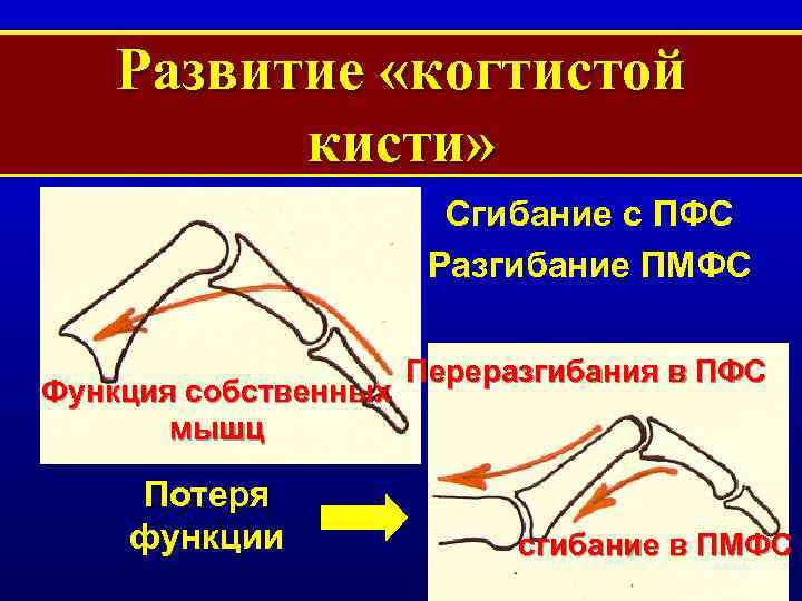 Развитие «когтистой кисти» Сгибание с ПФС Разгибание ПМФС Функция собственных мышц Потеря функции Переразгибания
