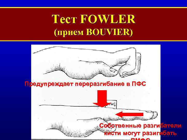 Тест FOWLER (прием BOUVIER) Предупреждает переразгибание в ПФС Собственные разгибатели кисти могут разигибать 