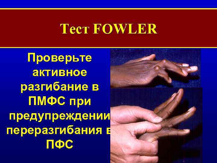 Тест FOWLER Проверьте активное разгибание в ПМФС при предупреждении переразгибания в ПФС 