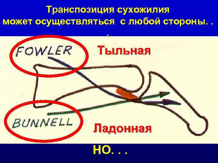 Транспозиция сухожилия может осуществляться с любой стороны. . . Тыльная Ладонная НО. . .
