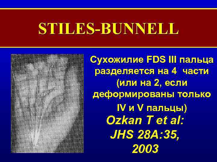 STILES-BUNNELL Сухожилие FDS III пальца разделяется на 4 части (или на 2, если деформированы