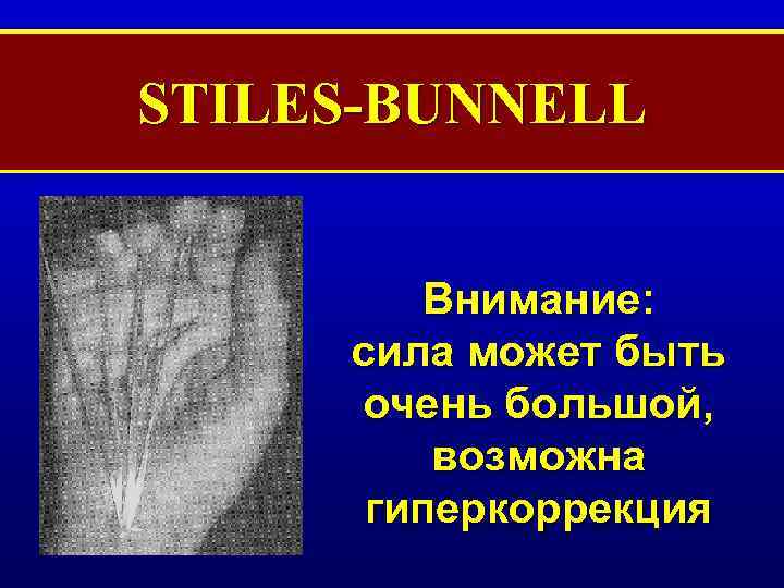STILES-BUNNELL Внимание: сила может быть очень большой, возможна гиперкоррекция 