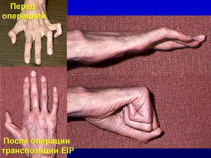 Перед операцией После операции транспозиции EIP 