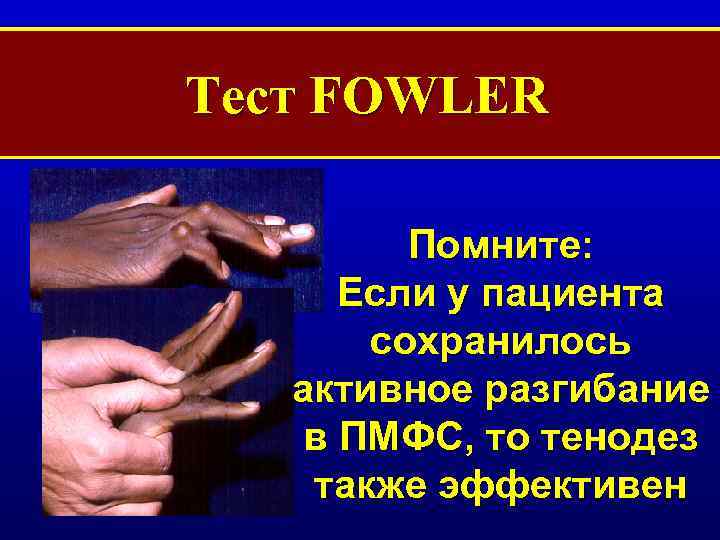 Тест FOWLER Помните: Если у пациента сохранилось активное разгибание в ПМФС, то тенодез также