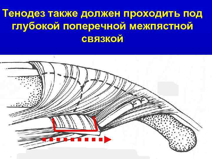 Тенодез также должен проходить под глубокой поперечной межпястной связкой 