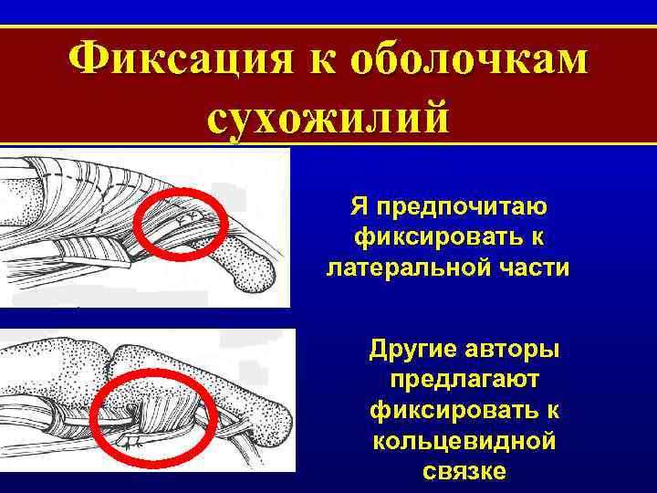 Фиксация к оболочкам сухожилий Я предпочитаю фиксировать к латеральной части Другие авторы предлагают фиксировать
