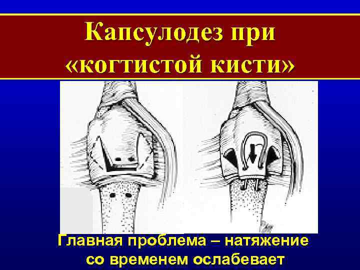 Капсулодез при «когтистой кисти» Главная проблема – натяжение со временем ослабевает 