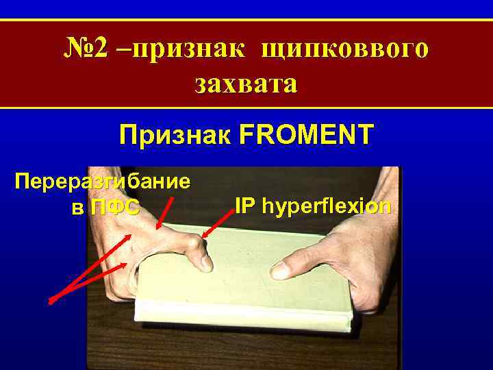 № 2 –признак щипковвого захвата Признак FROMENT Переразгибание в ПФС IP hyperflexion 