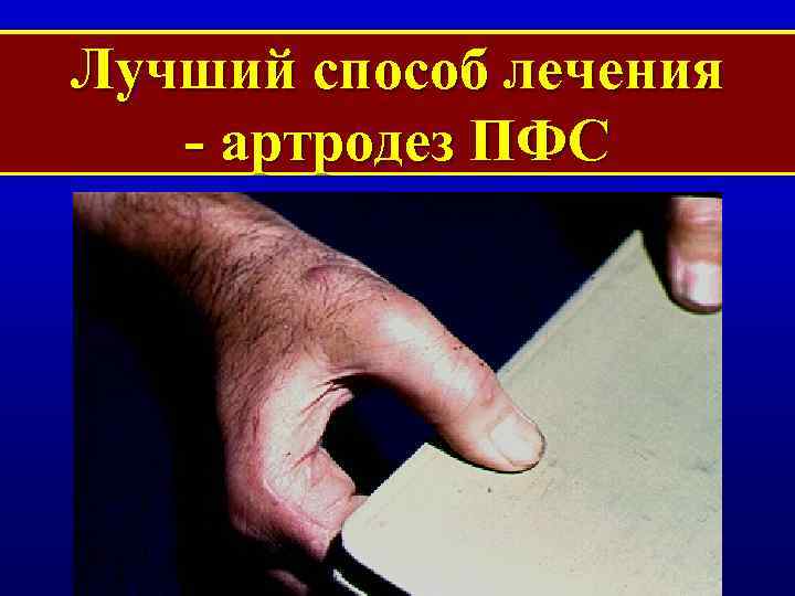 Лучший способ лечения - артродез ПФС 