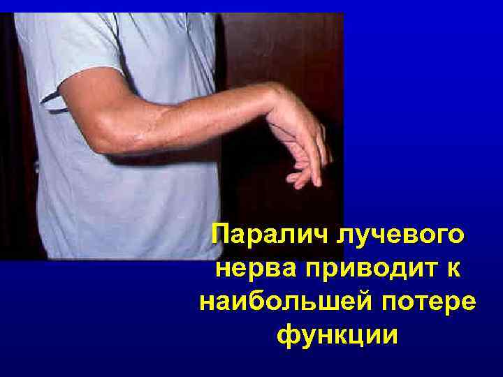 Паралич лучевого нерва приводит к наибольшей потере функции 