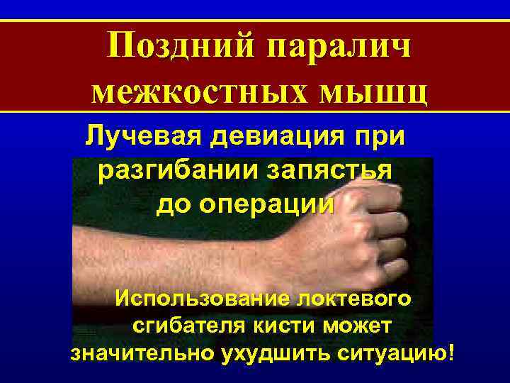 Поздний паралич межкостных мышц Лучевая девиация при разгибании запястья до операции Использование локтевого сгибателя