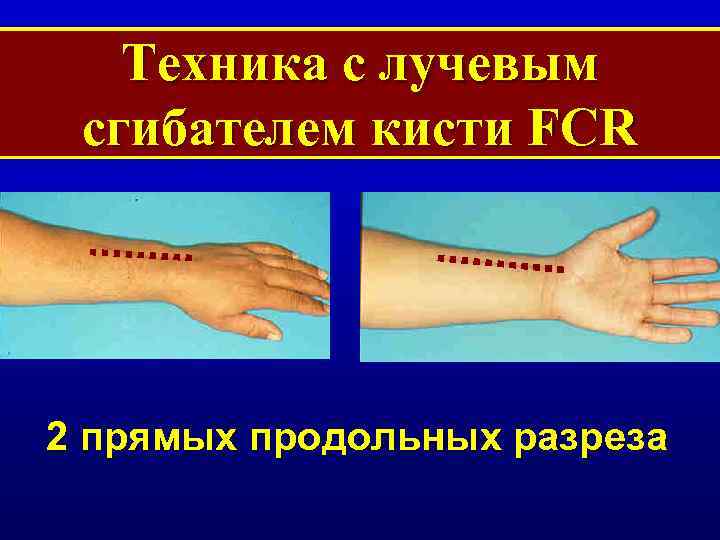 Техника с лучевым сгибателем кисти FCR 2 прямых продольных разреза 
