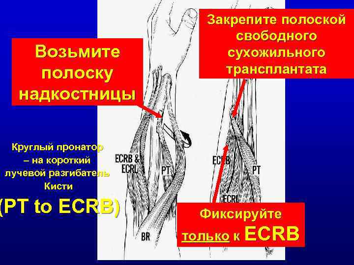 Возьмите полоску надкостницы Закрепите полоской свободного сухожильного трансплантата Круглый пронатор – на короткий лучевой