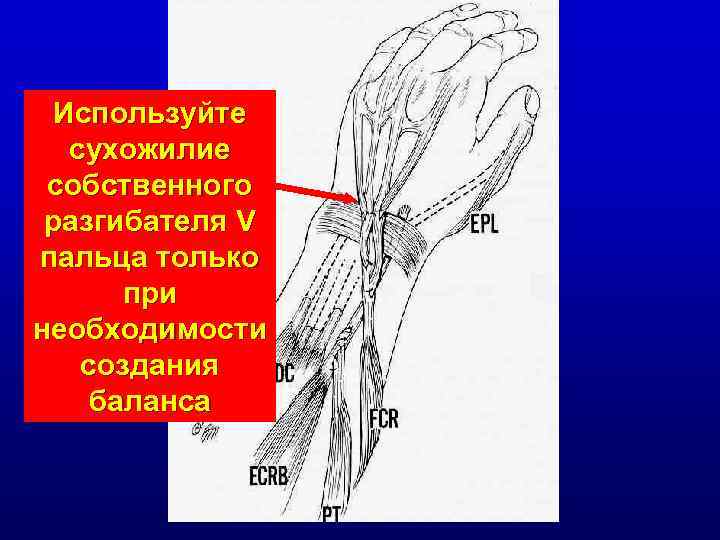 Используйте сухожилие собственного разгибателя V пальца только при необходимости создания баланса 