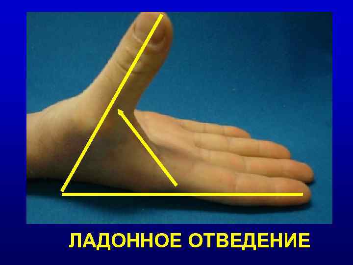 ЛАДОННОЕ ОТВЕДЕНИЕ 