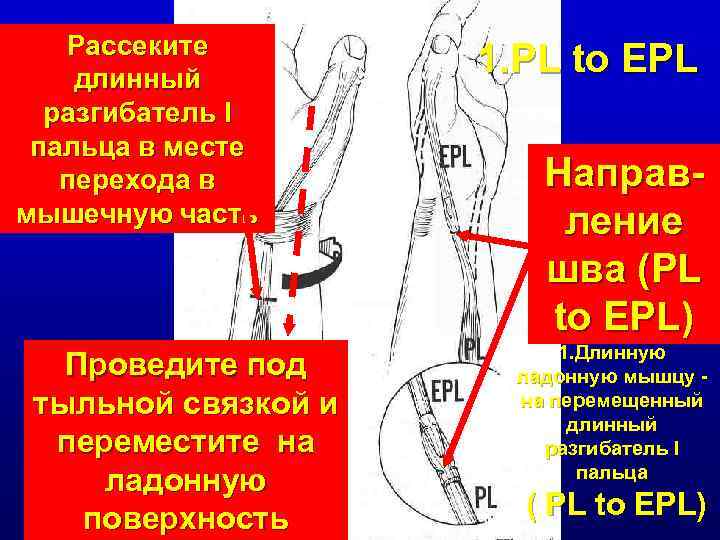 Рассеките длинный разгибатель I пальца в месте перехода в мышечную часть Проведите под тыльной