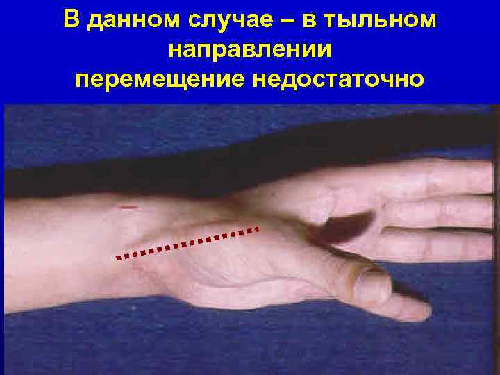 В данном случае – в тыльном направлении перемещение недостаточно 