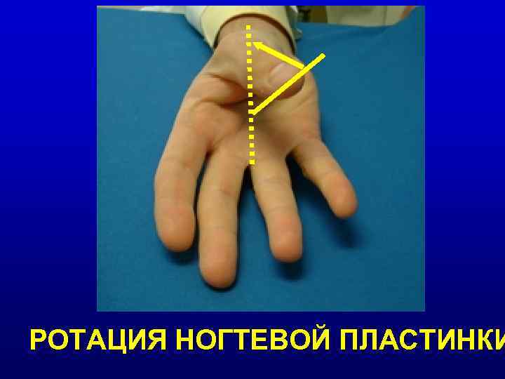 РОТАЦИЯ НОГТЕВОЙ ПЛАСТИНКИ 