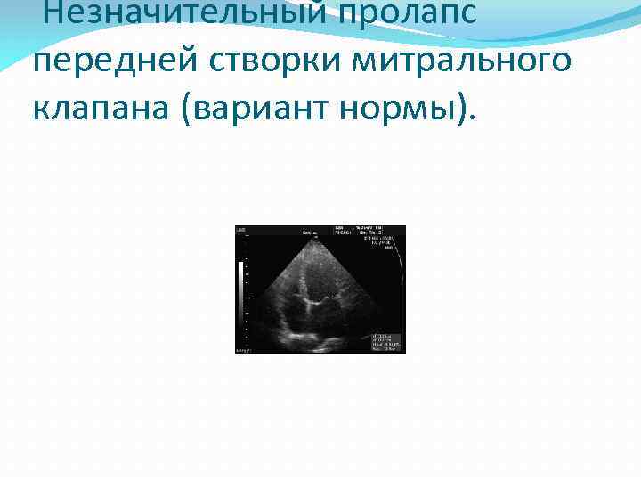  Незначительный пролапс передней створки митрального клапана (вариант нормы). 