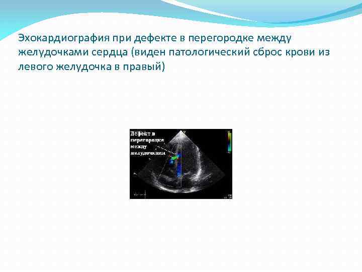 Эхокардиография при дефекте в перегородке между желудочками сердца (виден патологический сброс крови из левого