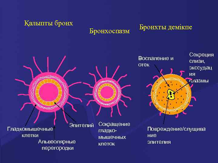 Қалыпты бронх Бронхоспазм Бронхты демікпе Воспаление и отек Эпителий Сокращение Гладкомышечные гладкоклетки мышечных Альвеолярные