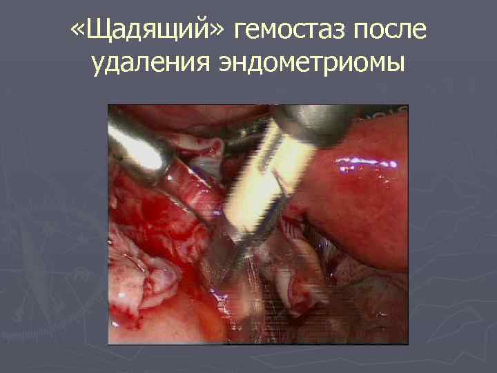  «Щадящий» гемостаз после удаления эндометриомы 