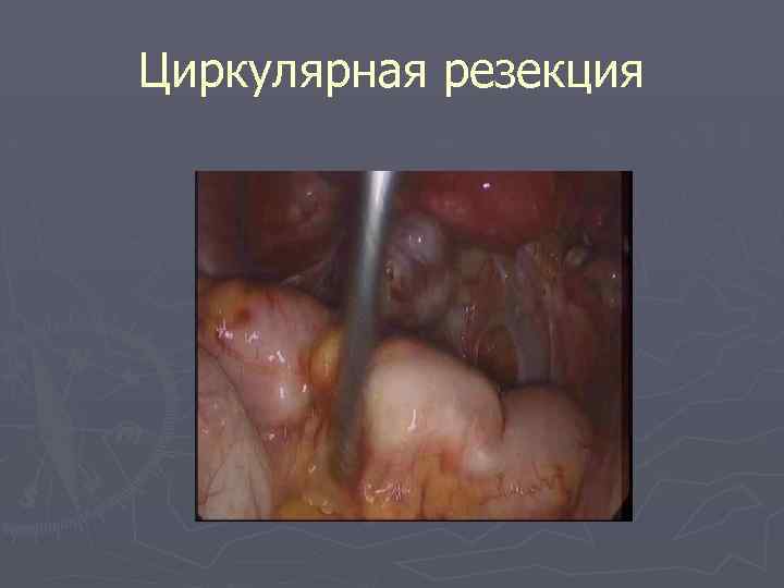 Циркулярная резекция 