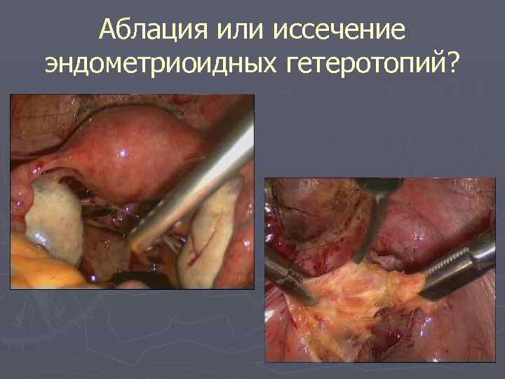 Аблация или иссечение эндометриоидных гетеротопий? 