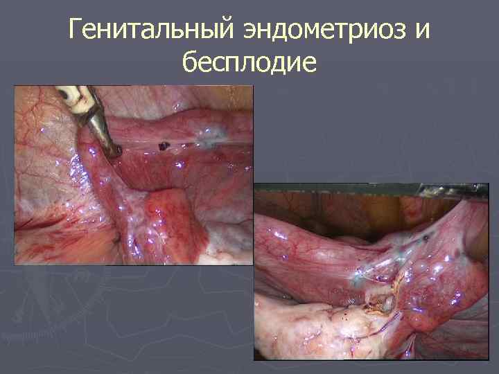 Генитальный эндометриоз и бесплодие 