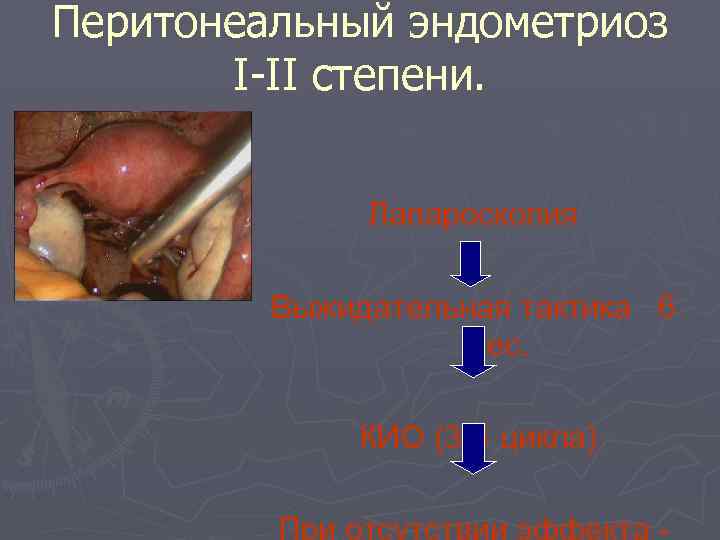 Перитонеальный эндометриоз I-II степени. Лапароскопия Выжидательная тактика 6 мес. КИО (3 -4 цикла) 