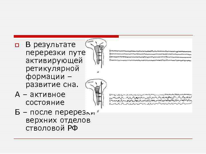 В результате перерезки путей активирующей ретикулярной формации – развитие сна. А – активное состояние