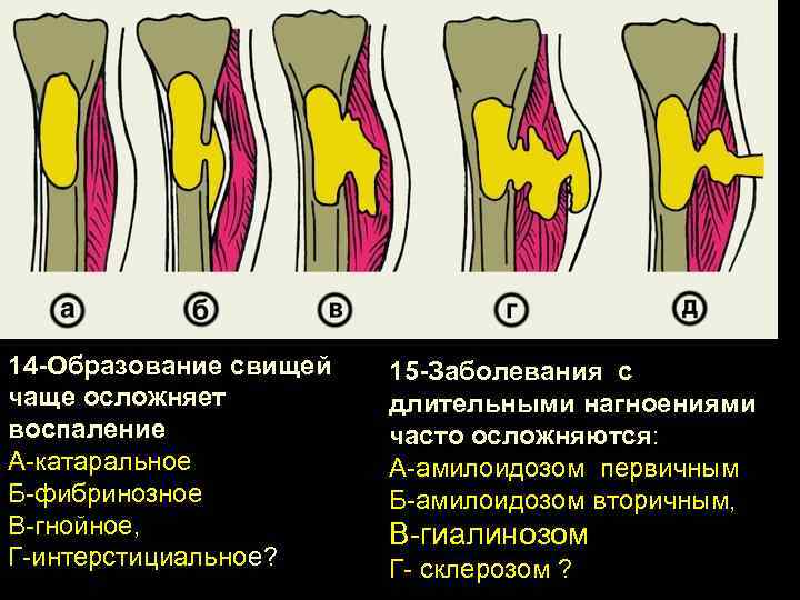 14 -Образование свищей чаще осложняет воспаление А-катаральное Б-фибринозное В-гнойное, Г-интерстициальное? 15 -Заболевания с длительными