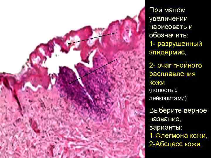 При малом увеличении нарисовать и обозначить: 1 - разрушенный эпидермис, 2 - очаг гнойного