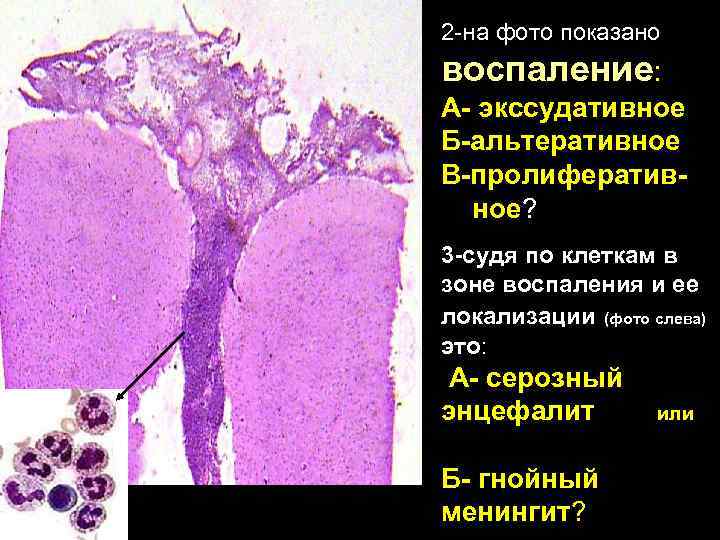 2 -на фото показано воспаление: А- экссудативное Б-альтеративное В-пролиферативное? 3 -судя по клеткам в