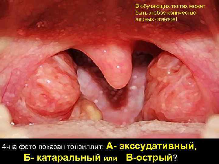 В обучающих тестах может быть любое количество верных ответов! А- экссудативный, Б- катаральный или