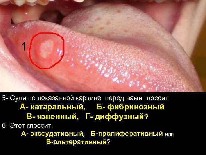 1 5 - Судя по показанной картине перед нами глоссит: А- катаральный, Б- фибринозный