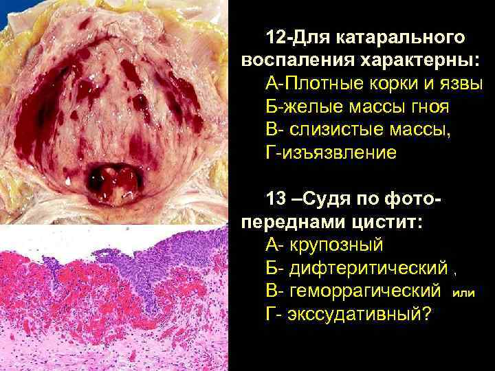 12 -Для катарального воспаления характерны: А-Плотные корки и язвы Б-желые массы гноя В- слизистые