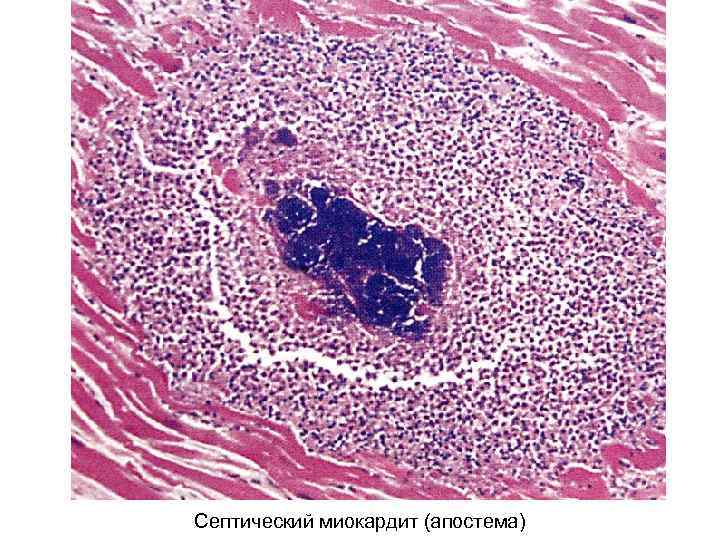 Септический миокардит (апостема) 