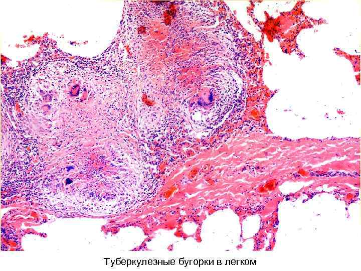 Туберкулезные бугорки в легком 
